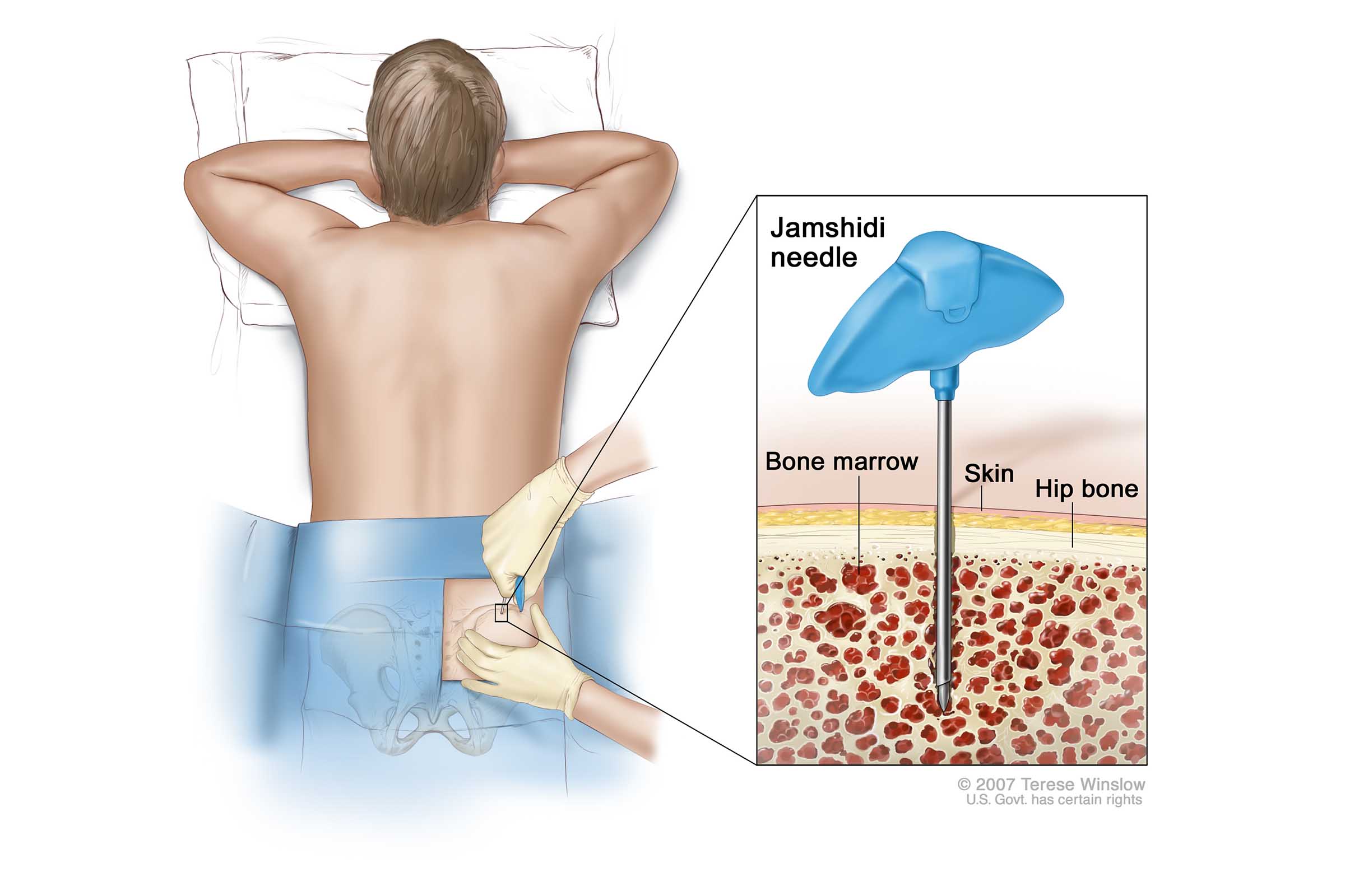 Figura ilustra coleta de medula óssea para transplantante.