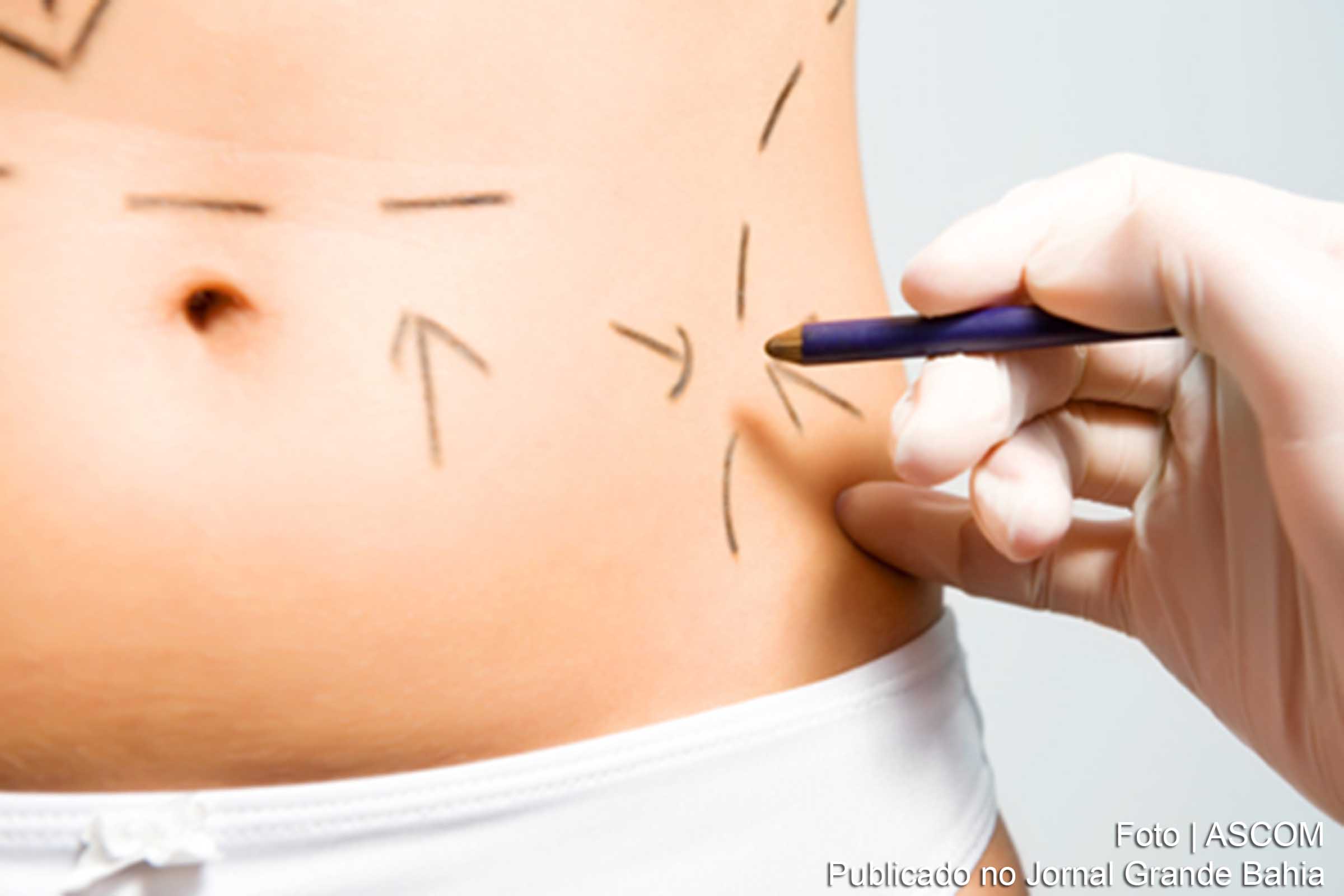 Lipoaspiração se destaca no ranking, sendo 90 mil cirurgias realizadas, por ano, no Brasil.