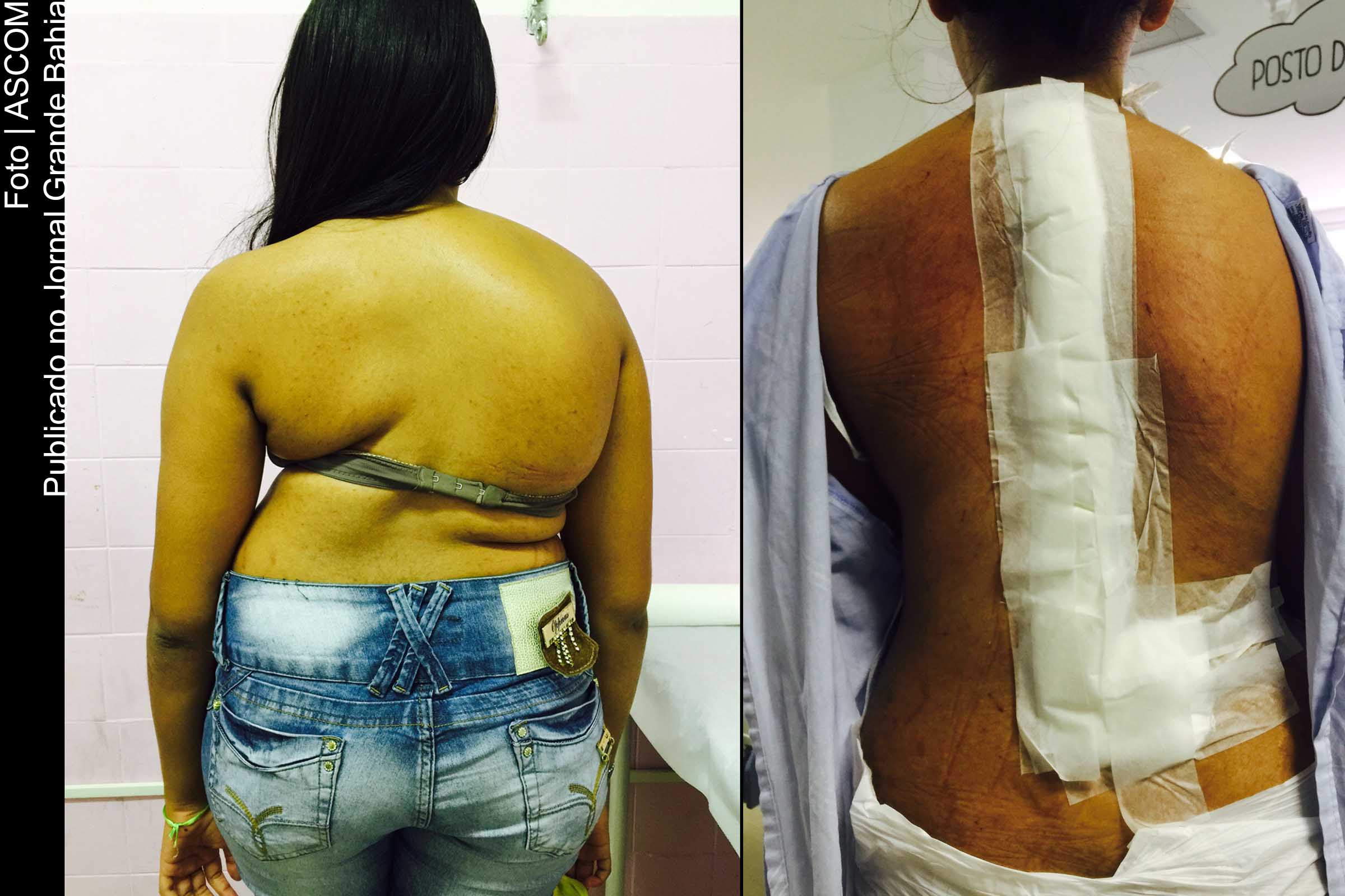 Cirurgia de coluna ortopédica é realziada pela primeira vez pelo Hospital Martagão Gesteira.