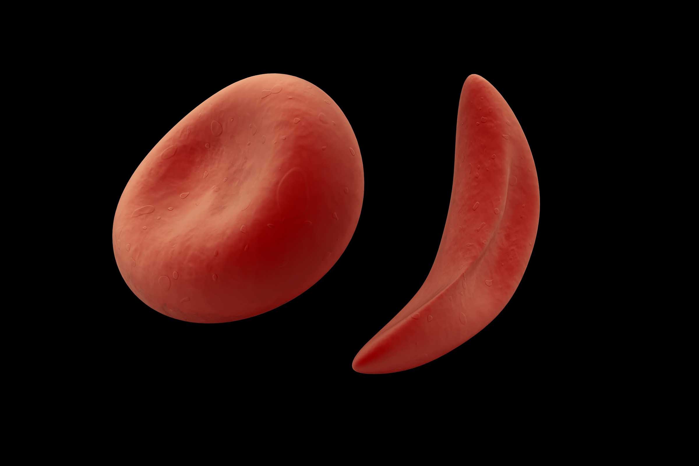 Imagem apresenta distinção de uma célula normal com relação a uma célula com anemia falciforme.