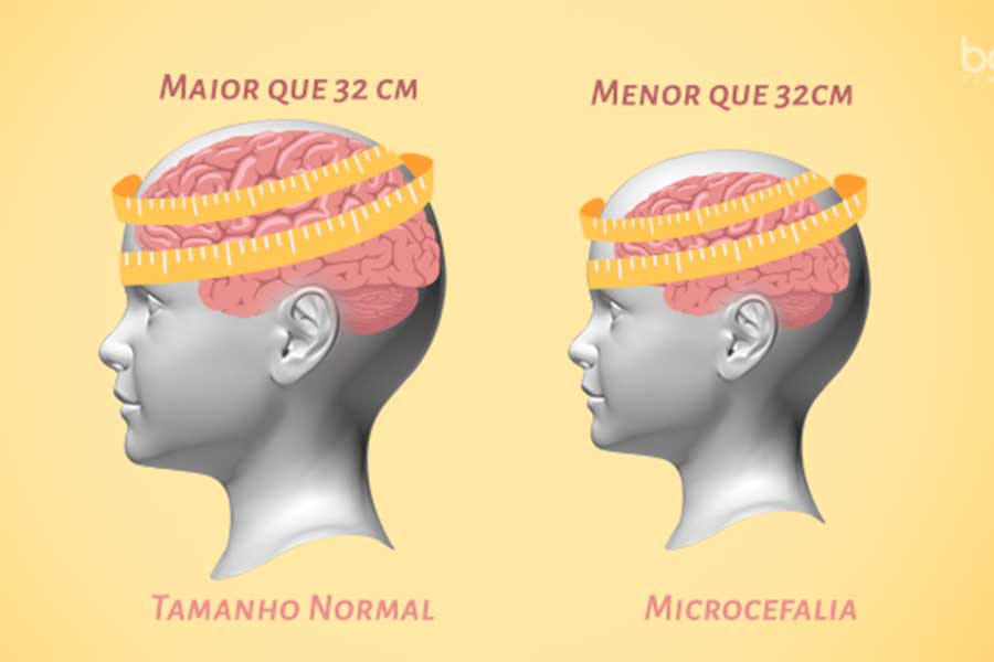 Bahia tem 161 casos confirmados de microcefalia.