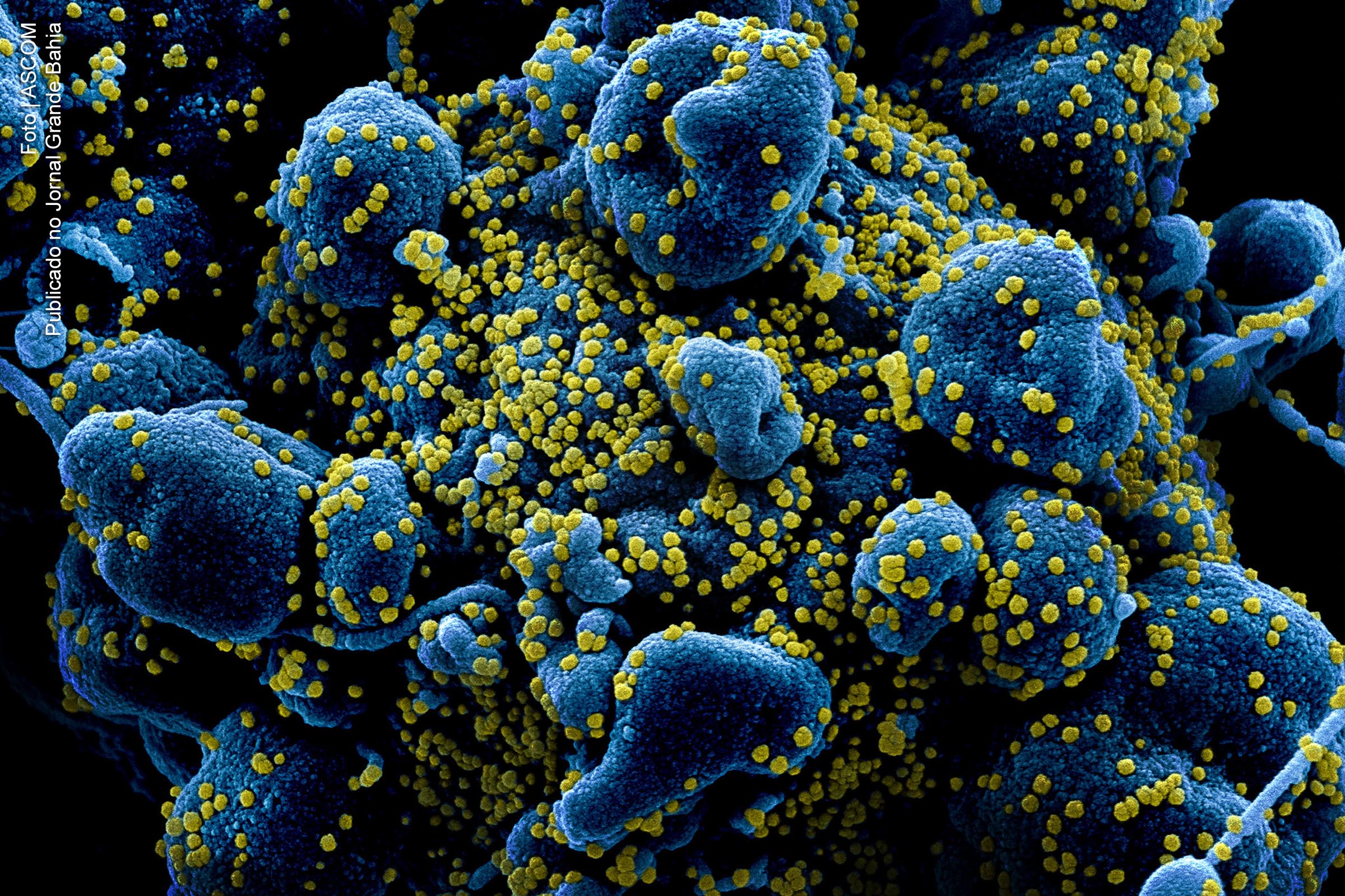 Célula apoptótica (azul) intensamente infectada com partículas do vírus Covid-19 (SARS-CoV-2)..