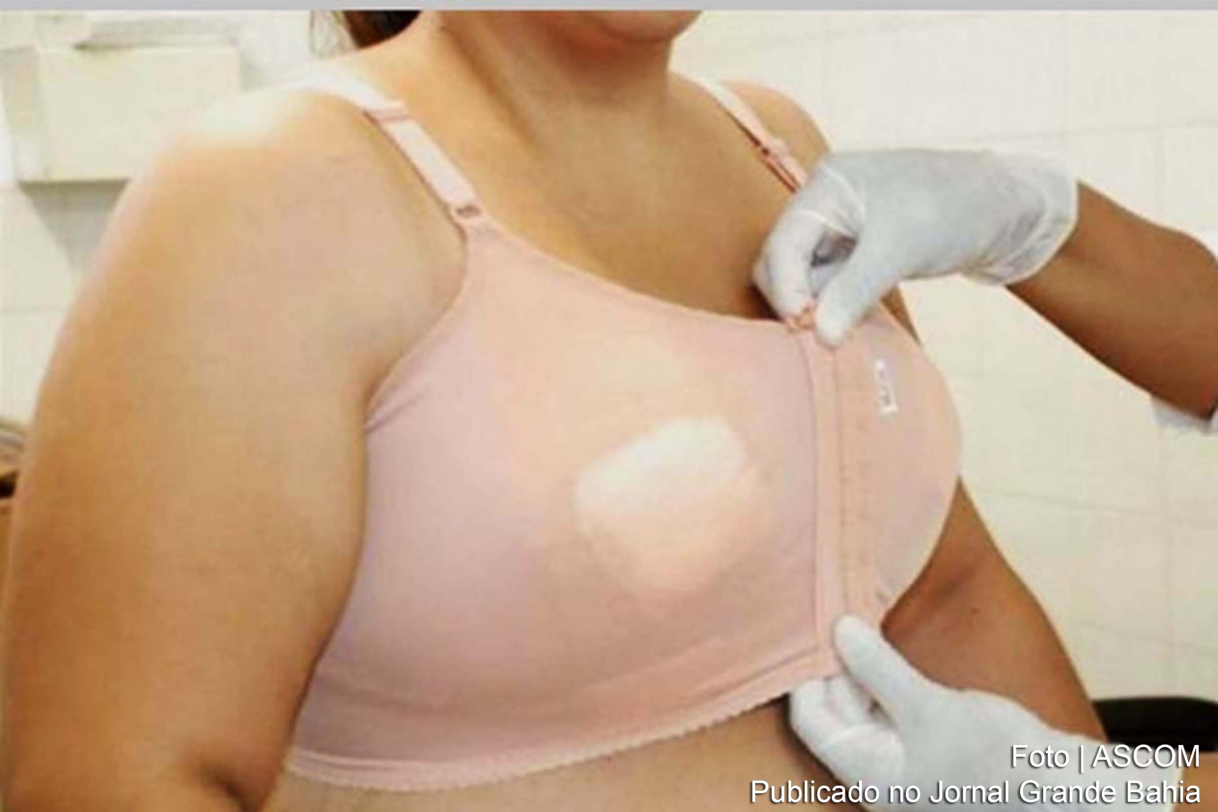 Prefeitura Municipal, por meio da Fundação Hospitalar de Feira de Santana (FHFS), adiou por tempo indeterminado a data do VII Mutirão para o Programa Municipal de Tratamento das Gigantomastias.