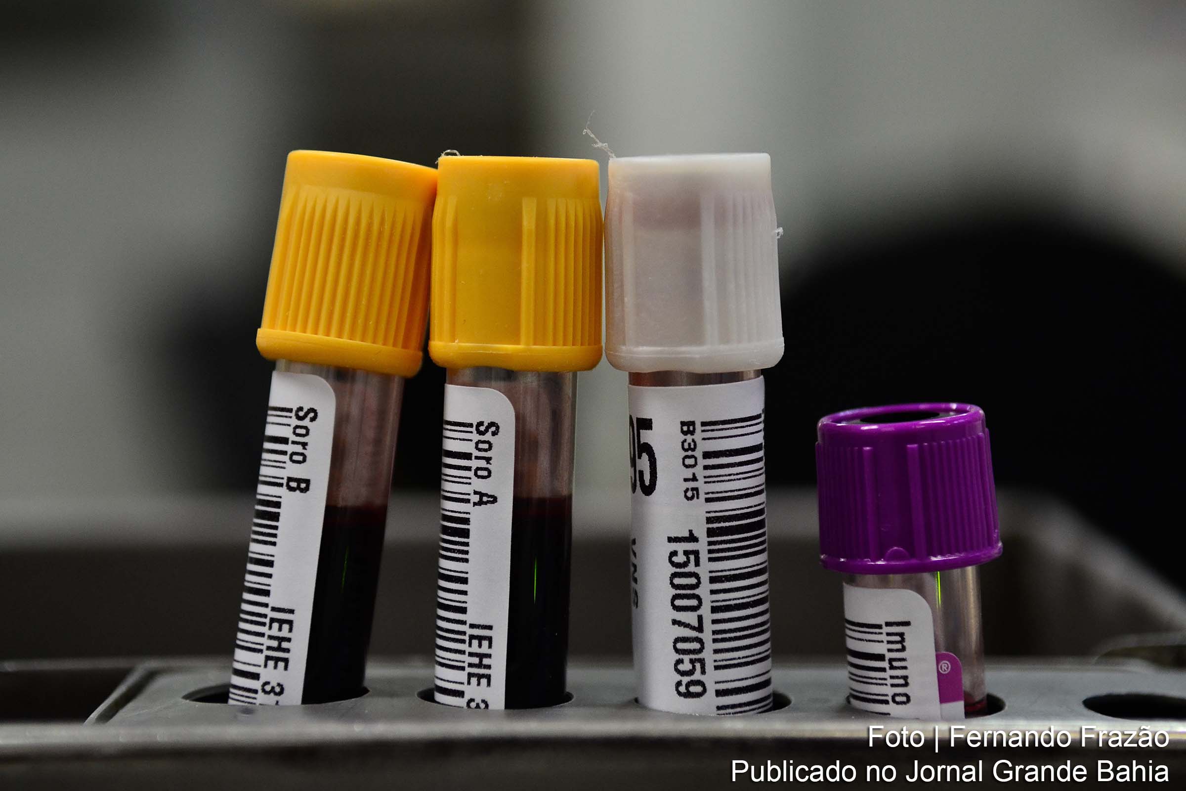 Plasma sanguíneo de pessoas que foram curadas do Covid-19 é usado em tratamento de pessoas com quadro grave da doença.