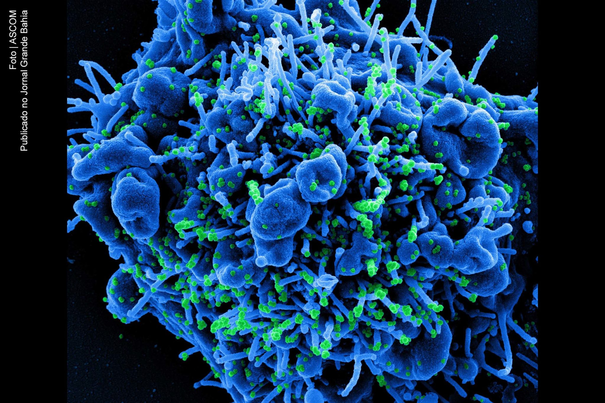 Micrografia eletrônica de varredura colorida de uma célula apoptótica (azul) infectada com partículas do vírus SARS-CoV-2 (verde), isolada de uma amostra de paciente.
