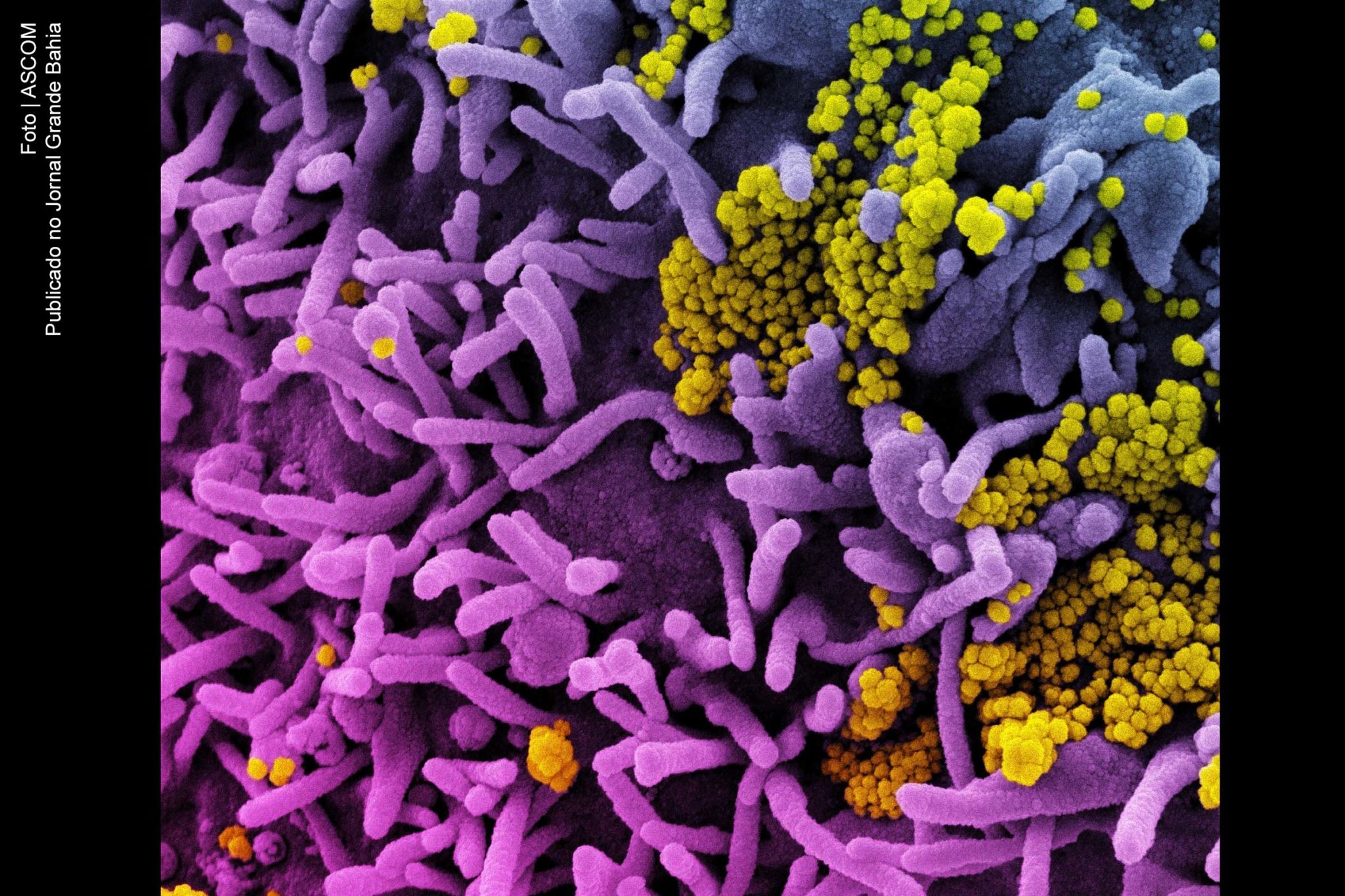 Micrografia eletrônica de uma célula (roxa) infectada com vírus SARS-CoV-2 (amarelo), isolada de uma amostra de paciente.