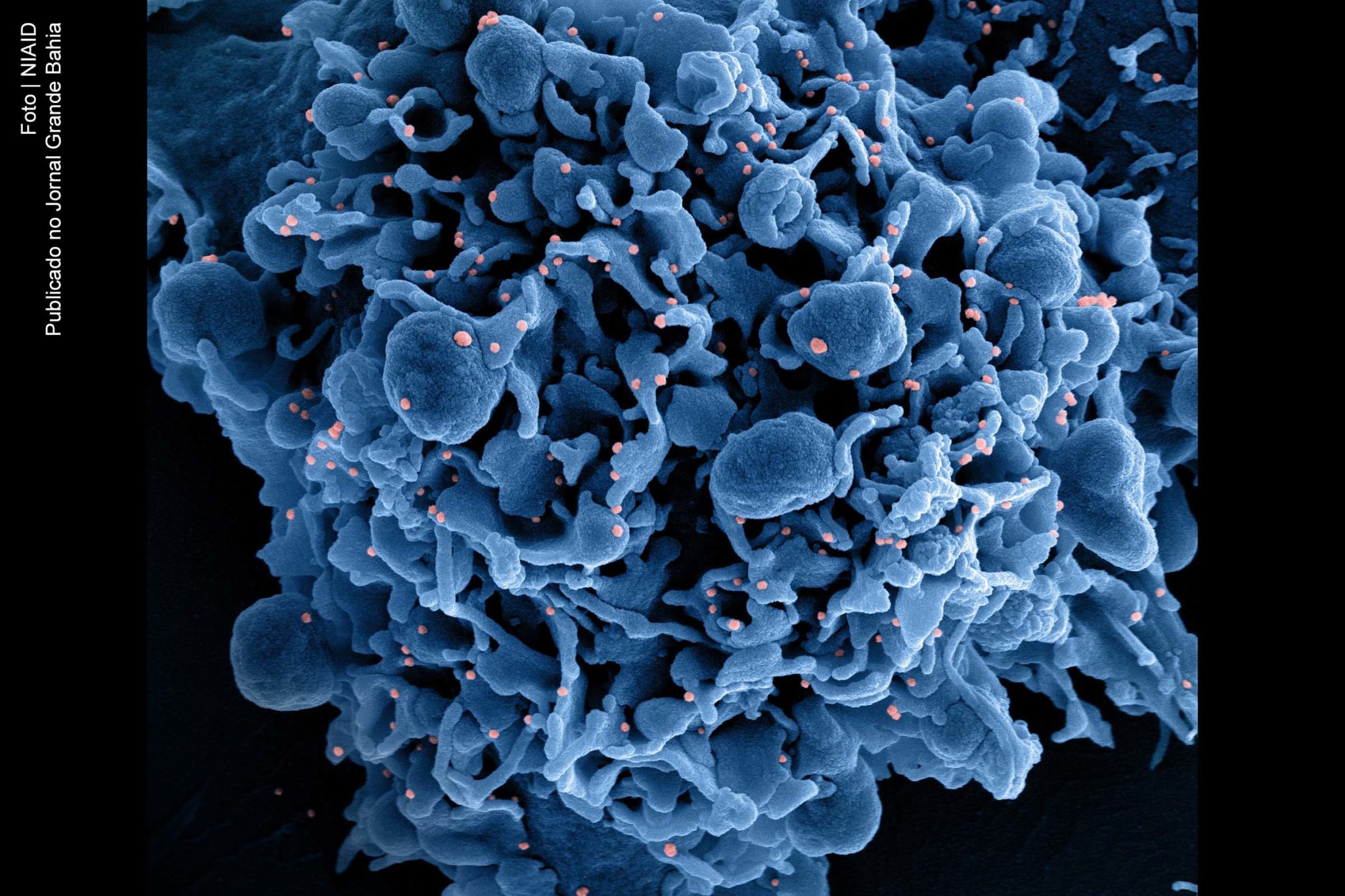 Micrografia eletrônica de varredura colorida de uma célula (azul) infectada com partículas do vírus SARS-CoV-2 (rosa), isolada de uma amostra de paciente. Imagem capturada no Centro de Pesquisa Integrada (IRF) do NIAID em Fort Detrick, Maryland.