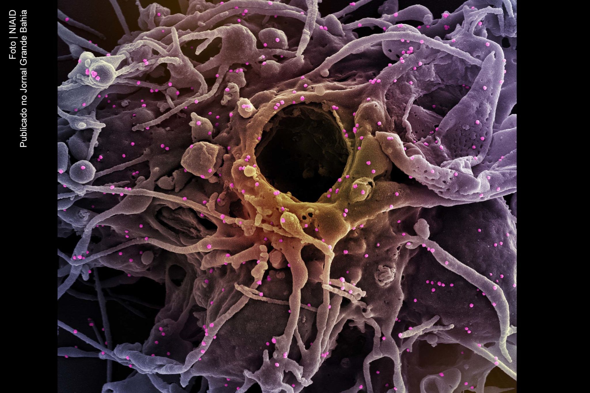 Denominada de P.4, cepa do SARS-CoV-2 foi detectada em vários municípios do interior do estado de São Paulo, e em ao menos um deles já circula livremente. Variante é derivada da P.1, originária de Manaus.