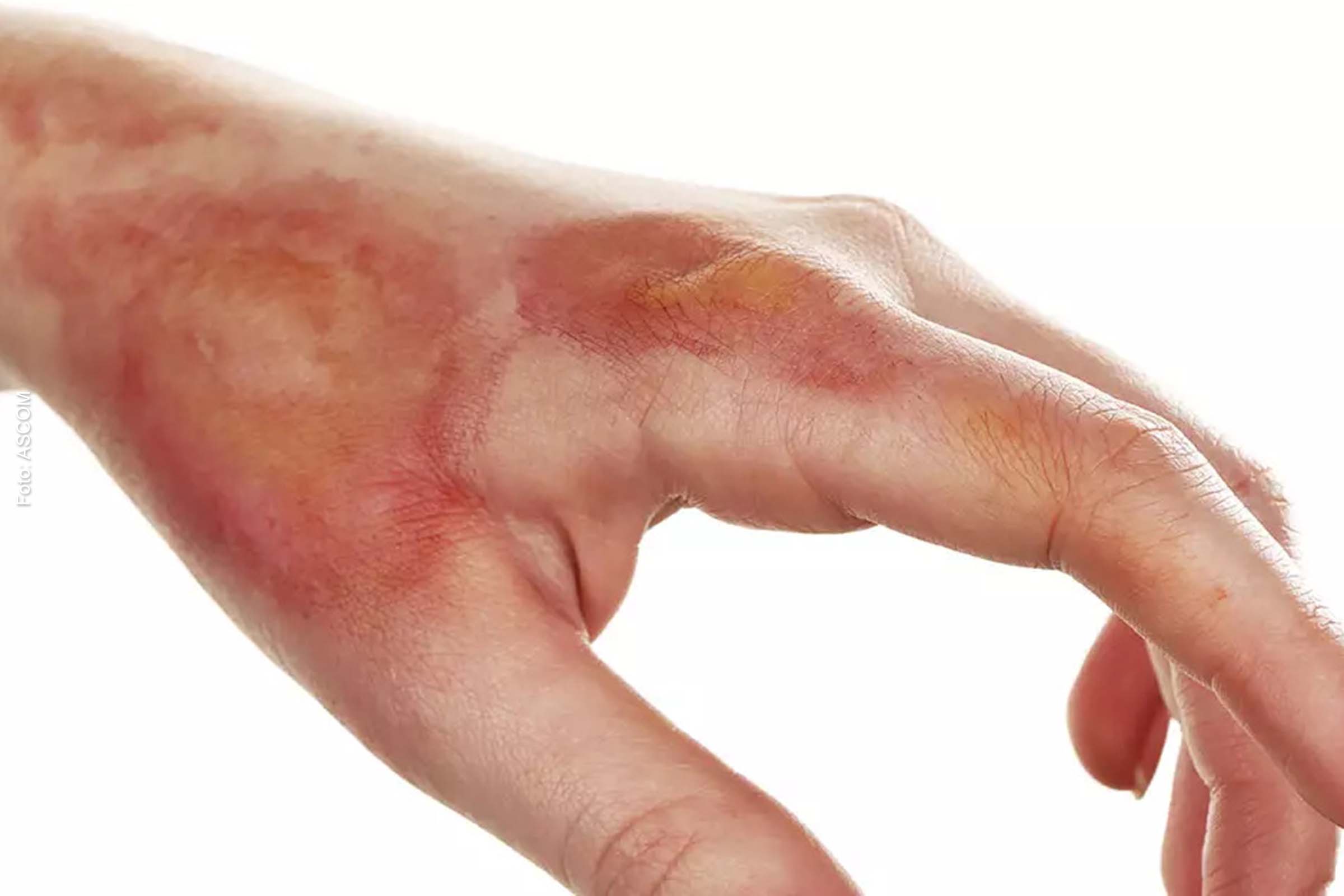 Queimaduras em crianças aumentaram mais de 30% na pandemia e médico orienta como prevenir e agir nesses casos.