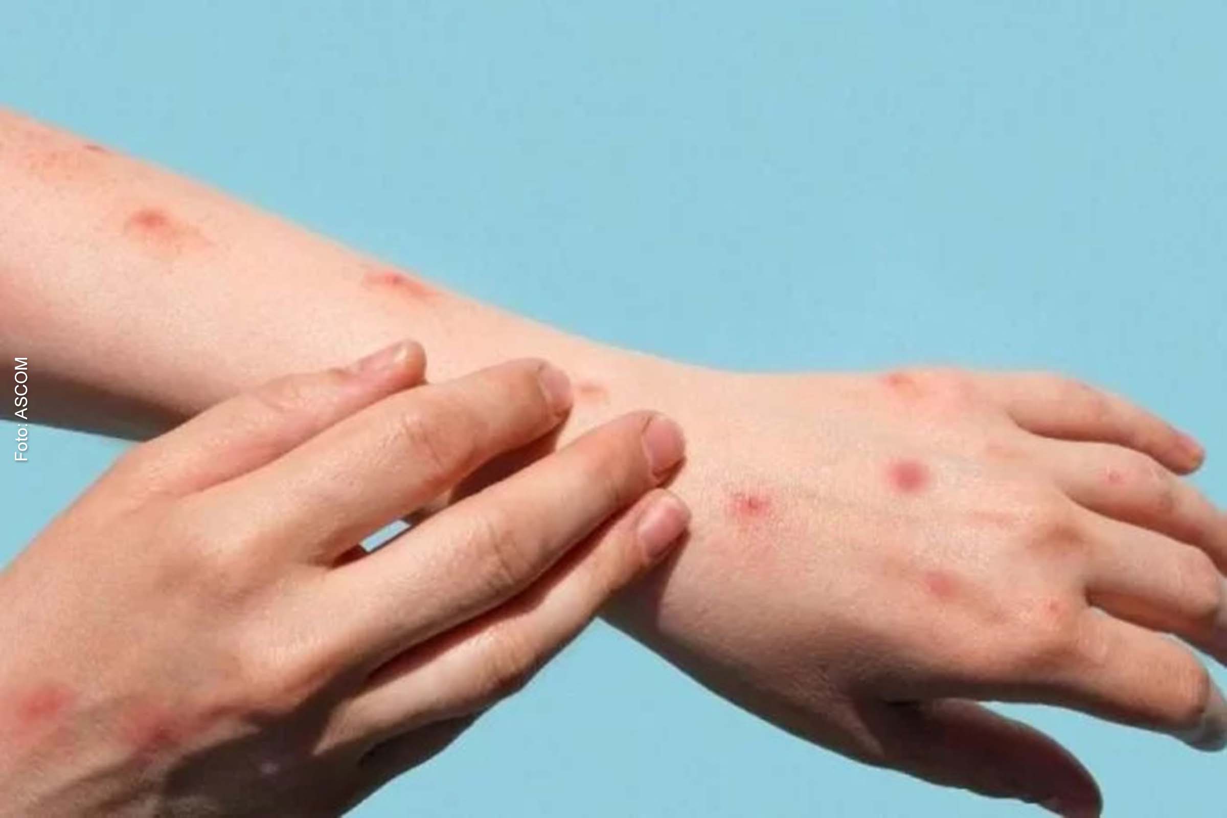 Paciente do sexo masculino tem 31 anos, reside na capital baiana e teve o início dos sintomas no dia 13 de julho de 2022.