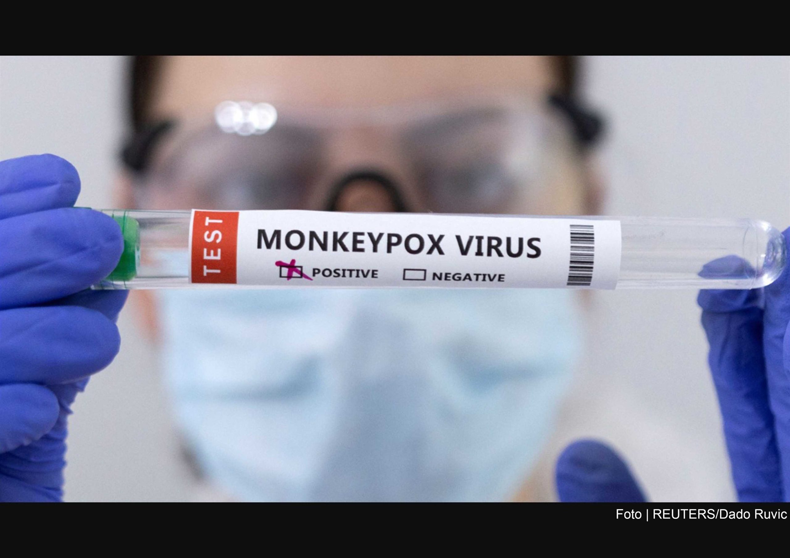 Monkeypox é uma zoonose viral, do gênero Orthopoxvirus, da família Poxviridae, que se assemelha à varíola humana, erradicada em 1980.