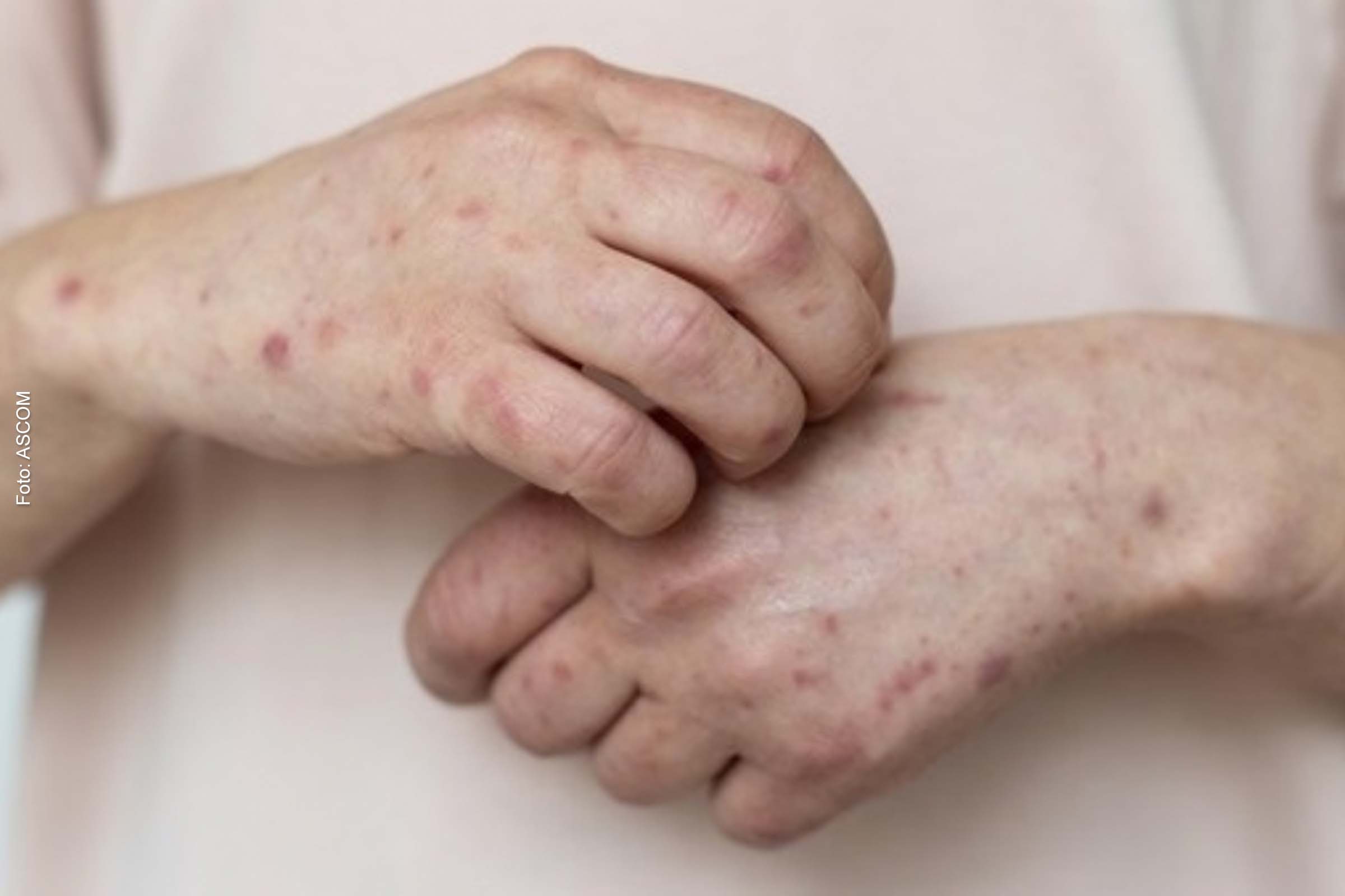 Os sintomas mais constantes nos feirenses que contraíram a doença foram lesões de pele, gânglios inflamados, dor de cabeça forte e febre alta.