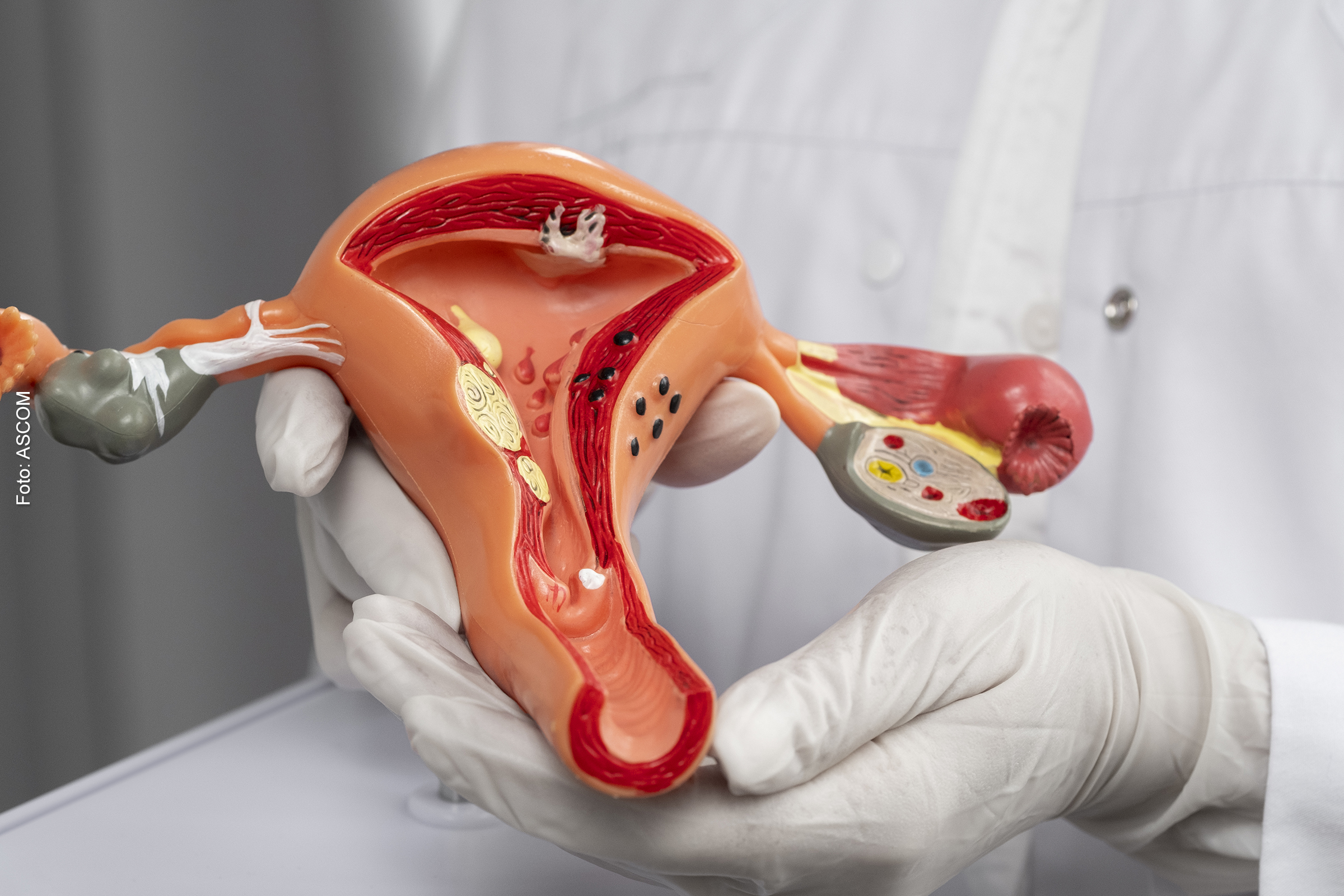 Além de dores, cerca de 40% das mulheres com endometriose apresentam transtornos psicológicos, afirma especialista.