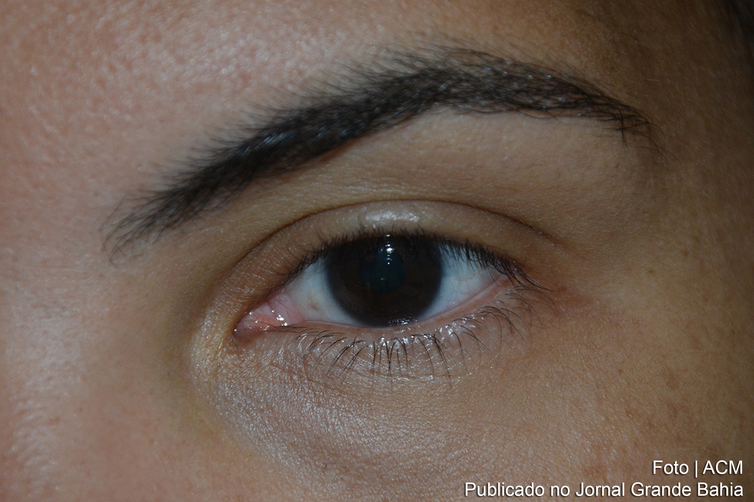 Prefeitura de Feira de Santana oferece 400 vagas para exames de glaucoma, visando diagnósticos precoces e prevenção da cegueira.
