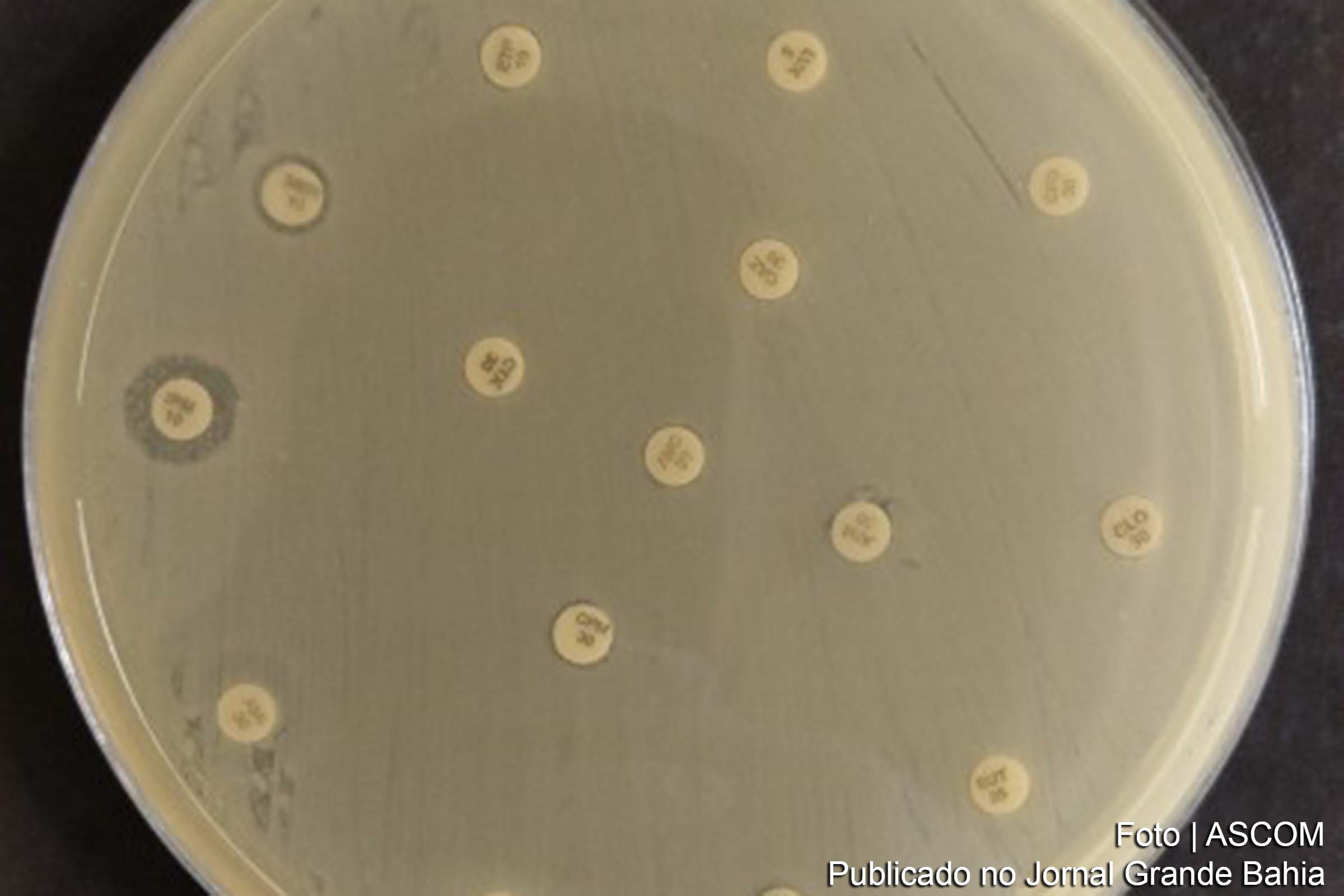 Descoberta de nova cepa da Klebsiella pneumoniae em paciente de 86 anos levanta preocupações sobre resistência bacteriana e disseminação mundial.