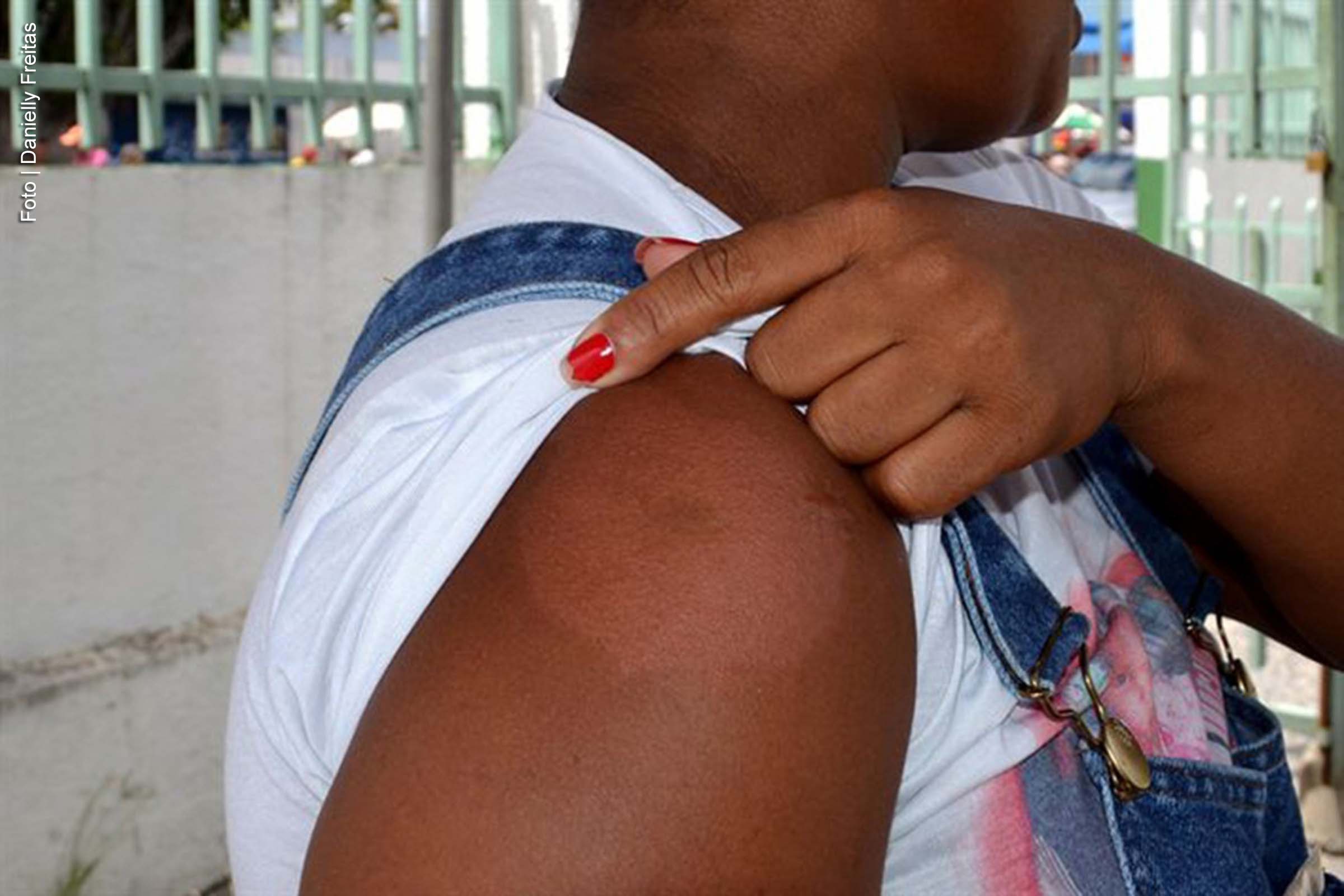 Janeiro Roxo: Feira de Santana registra aumento nos casos de hanseníase em 2024