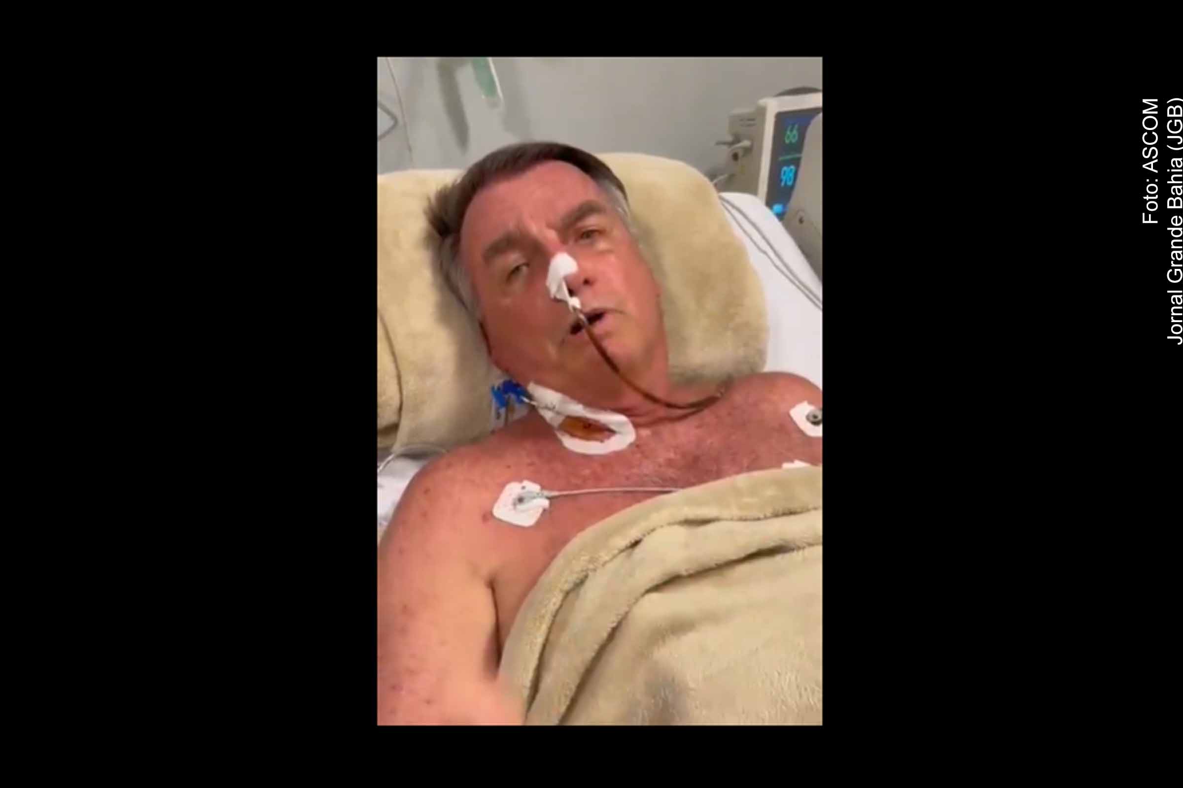 O ex-presidente Jair Bolsonaro foi submetido neste domingo (13/04/2025) a uma cirurgia no hospital DF Star, em Brasília, após ter sido transferido no sábado (12) de Natal (RN), onde foi internado com distensão abdominal. A informação foi confirmada pelo senador Rogério Marinho. A equipe médica ainda não detalhou o procedimento, que está relacionado às complicações abdominais recorrentes desde 2018.