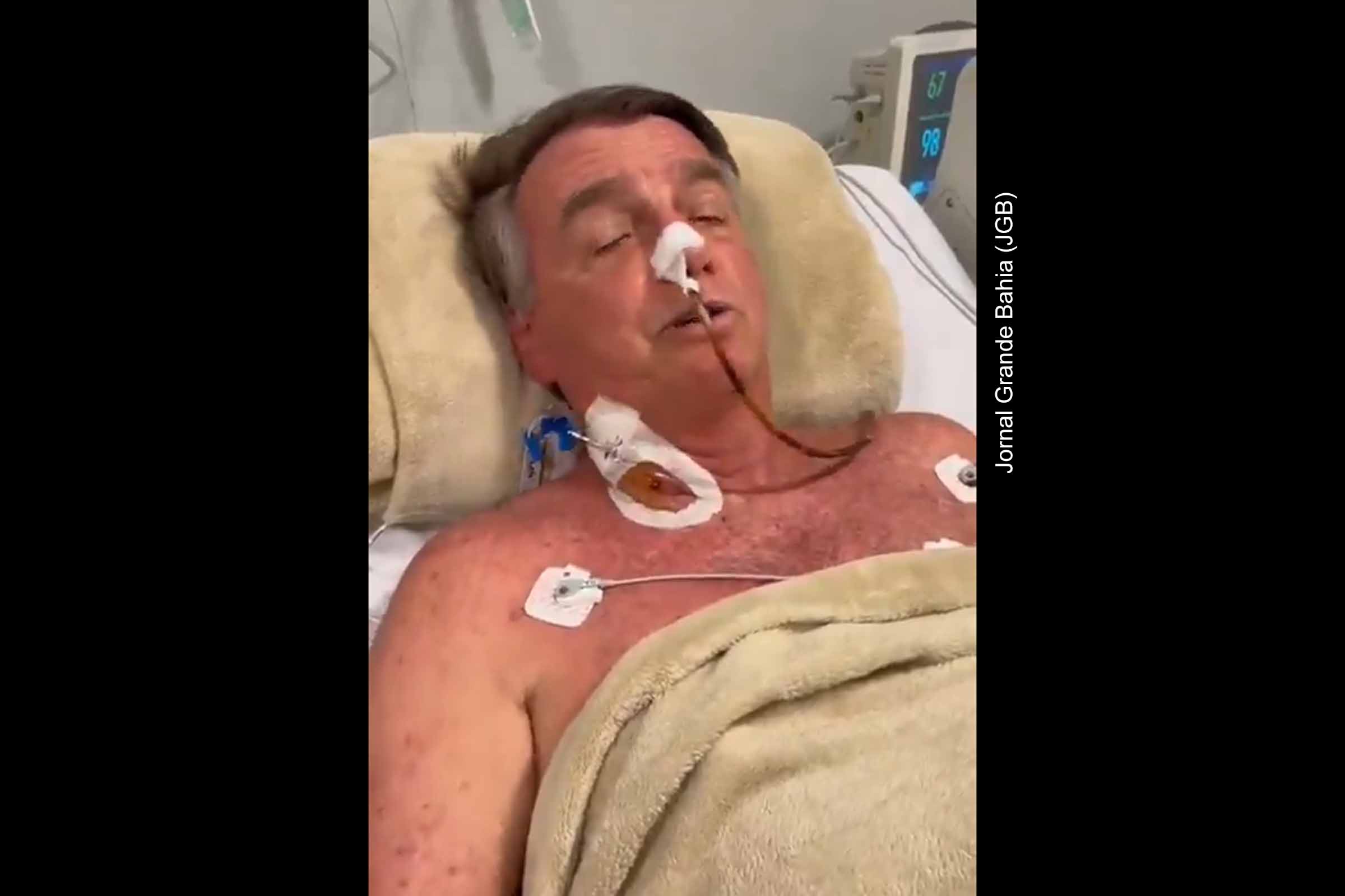 O ex-presidente Jair Bolsonaro foi submetido a uma cirurgia de grande porte no domingo (13/04/2025), em Brasília, para correção de uma obstrução intestinal. O procedimento durou 12 horas e foi realizado sem complicações. Segundo boletim médico, o paciente encontra-se estável na UTI, recebendo suporte clínico e nutricional. A equipe médica descartou necessidade de transfusão e indicou que a recuperação será monitorada intensamente nos próximos dias.